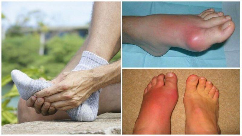 Is it possible to eat beets if you have gout: let’s look at the arguments for and against