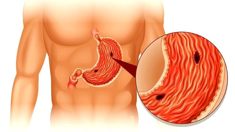 Is it possible to eat melon if you have a stomach ulcer: arguments for and against, contraindications