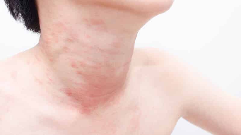 Can an allergy to rice occur and how does it manifest itself?