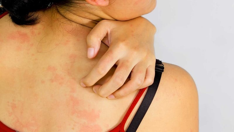 Can an allergy to rice occur and how does it manifest itself?