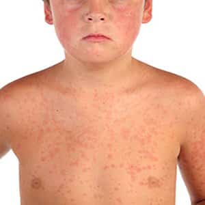Can an allergy to rice occur and how does it manifest itself?