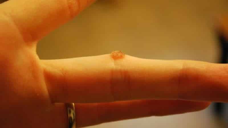 How to get rid of warts using potatoes