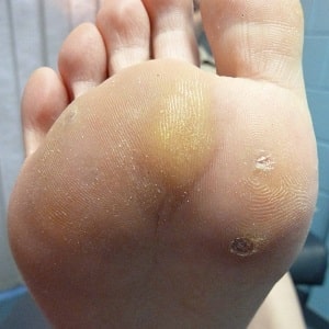 How to get rid of warts using potatoes