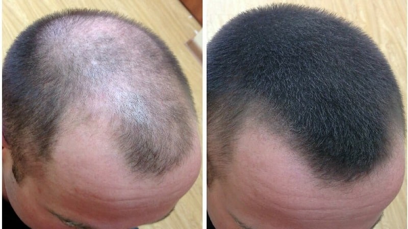 Onion hair masks for the treatment of baldness