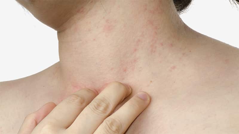 Can an allergy to carrots occur, how does it manifest itself and how is it treated?