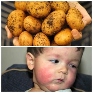 How does potato allergy manifest in children and adults?