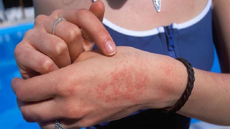 How does potato allergy manifest in children and adults?