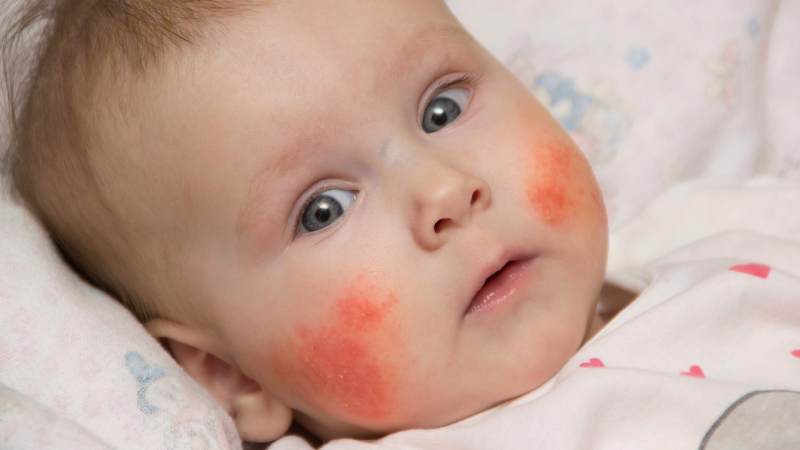 Are infants allergic to buckwheat?