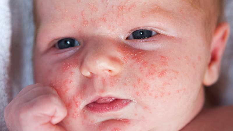 Are infants allergic to buckwheat?