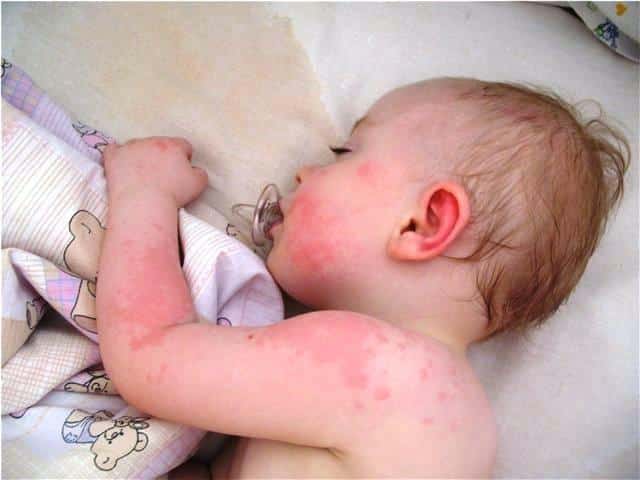Is there an allergy to cauliflower in infants?