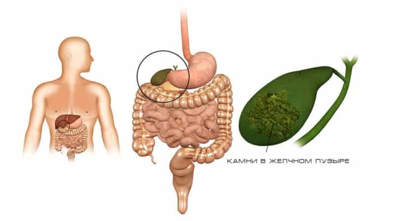 Watermelon for gallstones: can you eat it and in what quantities?
